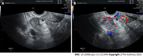 ovarian torsion diagnostic test|ovarian torsion vs ectopic pregnancy.